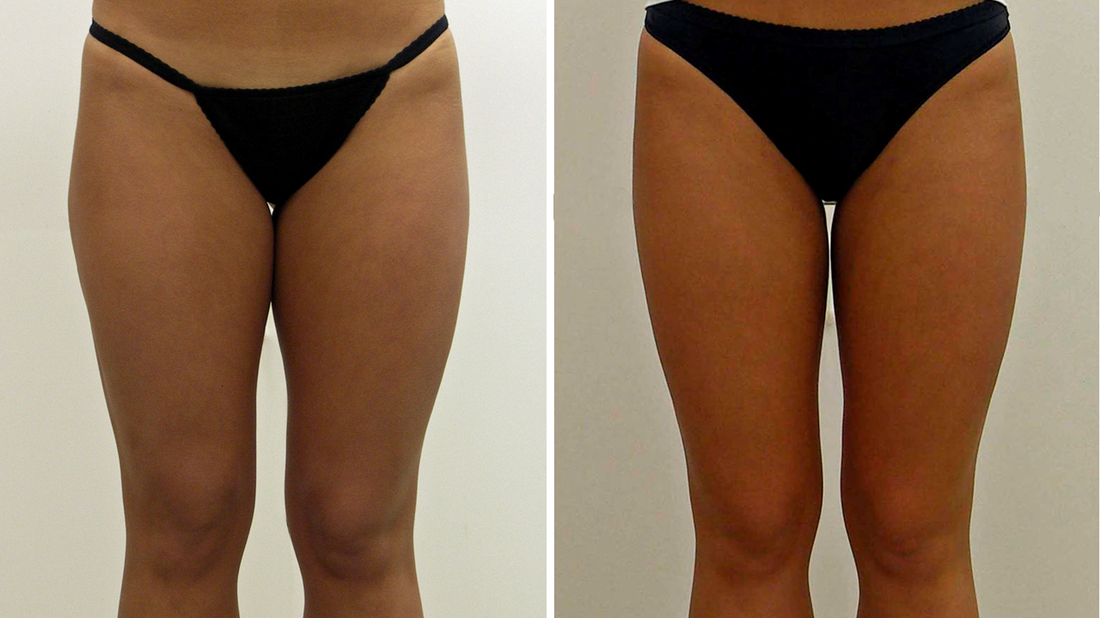 Thigh & Knee Liposuction / Houston Lipo Center